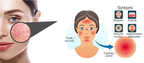 Infografica sui fattori scatenanti comuni della rosacea e strategie per evitarli