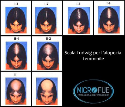 Schema della scala Ludwig per la calvizie femminile