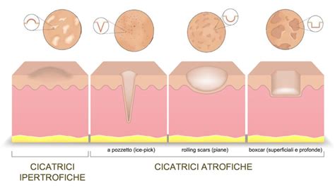 Diagramma che illustra un approccio multimodale al trattamento delle cicatrici da acne, mostrando la combinazione di diverse tecniche