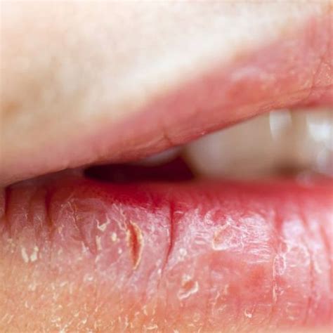 Immagine ravvicinata di labbra screpolate dal freddo