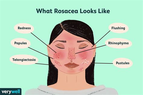 Schema dei sintomi della rosacea
