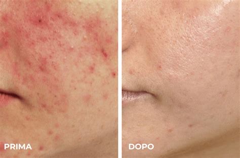 Diagramma del funzionamento del trattamento laser per la rosacea