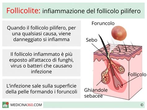 Schema che illustra le cause della follicolite: rasatura, sudorazione, indumenti stretti
