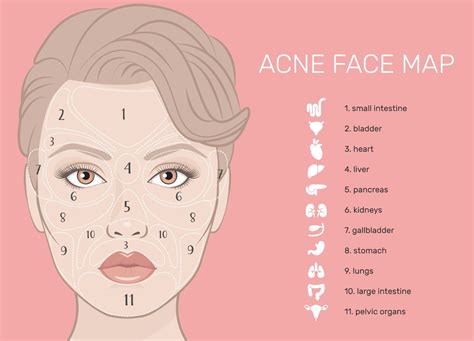 Mappa del viso con zone di acne adulta