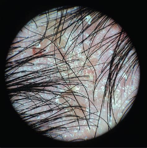 Immagine di una persona con eruzioni cutanee tipiche della dermatite seborroica sul cuoio capelluto e sul viso.