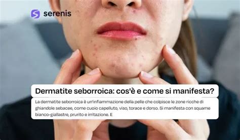 Illustrazione delle diverse aree del corpo comunemente colpite dalla dermatite seborroica.