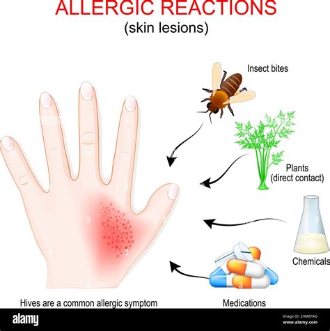 illustrazione di una reazione allergica cutanea con rossore e prurito