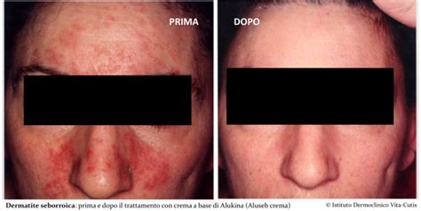 illustrazione della dermatite seborroica sul viso