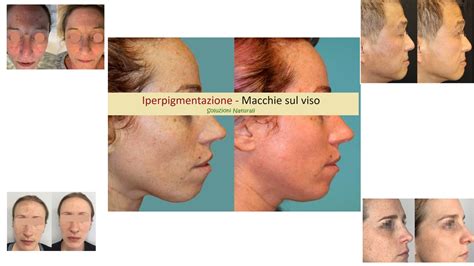 schema che illustra le diverse opzioni di trattamento per le macchie sul viso