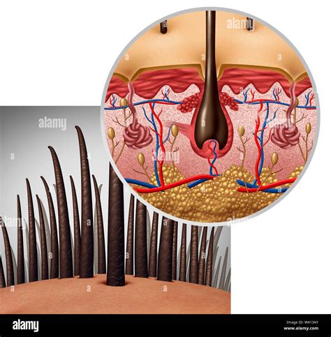 Illustrazione schematica del cuoio capelluto umano con evidenziate le aree interessate dalla psoriasi.