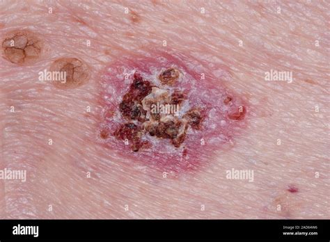 Illustrazione di un carcinoma basocellulare sulla pelle