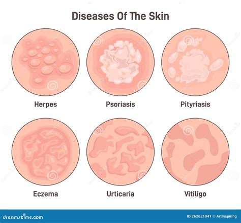 Immagine di una pelle sana e di una pelle affetta da psoriasi o eczema