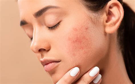 Pelle arrossata sul viso