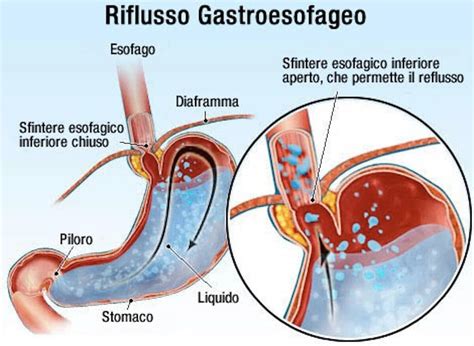 Diagramma che illustra il reflusso gastroesofageo e la sua irritazione delle vie respiratorie