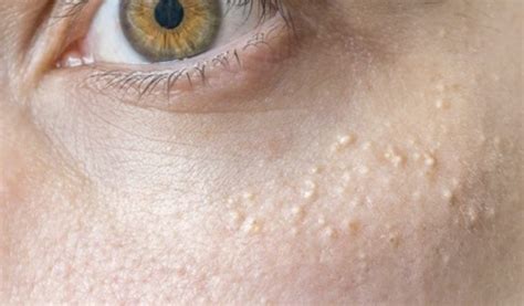 grani di miglio sul viso