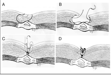 Diagramma che illustra la tecnica chirurgica di escissione del basalioma