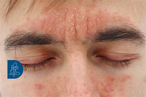 Immagine che mostra la distribuzione della dermatite seborroica sul viso e sul cuoio capelluto