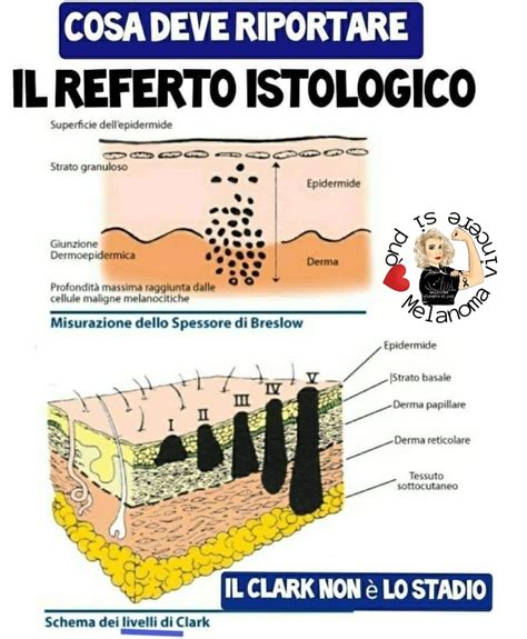 Esempio visivo di melanoma a diffusione superficiale