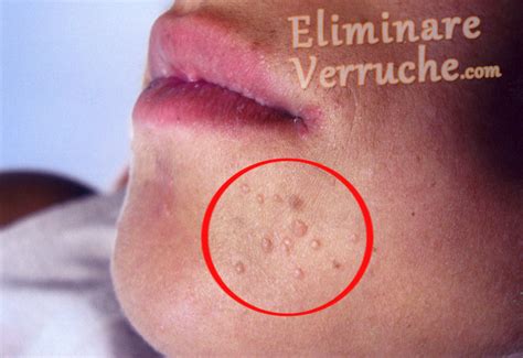 Bambino con verruche sul viso