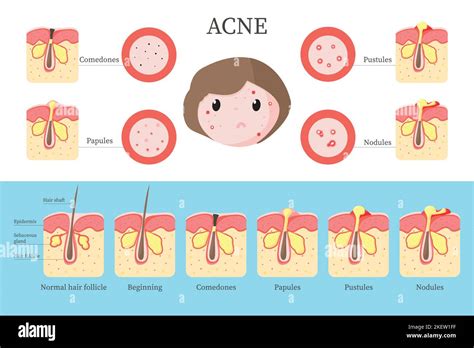 Diagramma del follicolo pilosebaceo con le fasi dell'acne