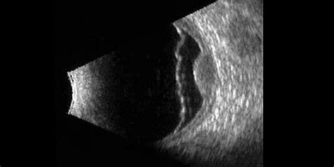 Immagine che illustra una ecografia oculare e una angiografia retinica