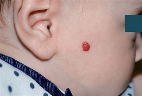 Illustrazione di un emangioma infantile sul viso di un bambino
