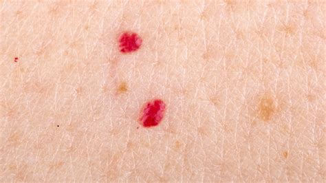 Medico che esamina un angioma cutaneo