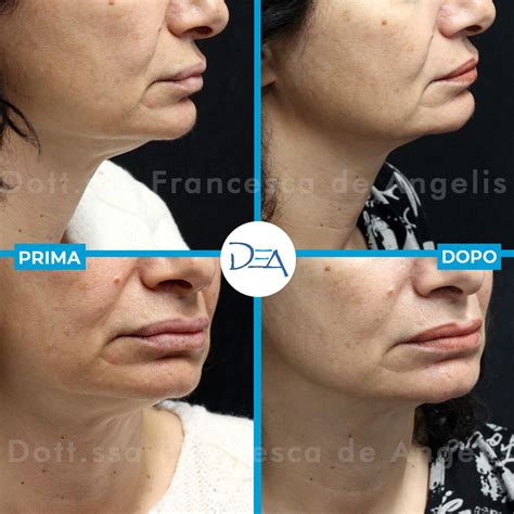 Prima e dopo trattamento con acido mandelico