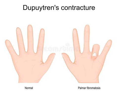 Illustrazione che mostra la differenza tra una mano sana e una mano con deformità a 