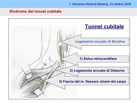 Diagramma illustrativo delle tecniche chirurgiche per la sindrome del tunnel cubitale (decompressione e trasposizione)