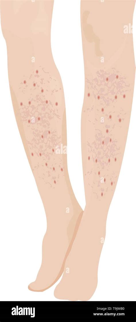 illustrazione di pseudofollicolite sulle gambe