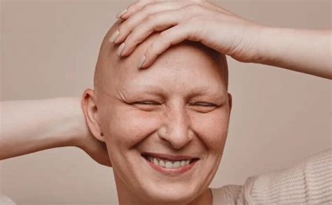 Manifestazione di pazienti per chiedere il riconoscimento dell'alopecia areata