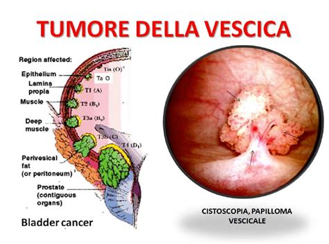 Immagine di un'endoscopia che mostra un'area di recidiva tumorale nel retto