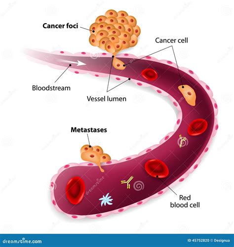 Diagramma che illustra le comuni sedi di metastasi del cancro del colon-retto