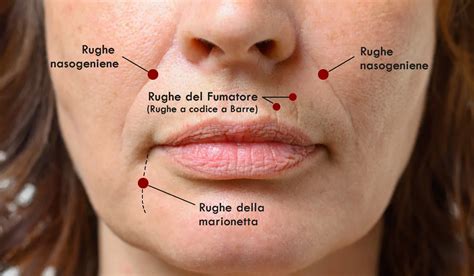 Illustrazione schematica del contorno labbra con evidenziazione delle rughe sottili