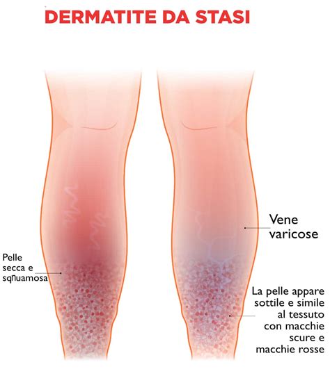 Gambe con dermatite da stasi