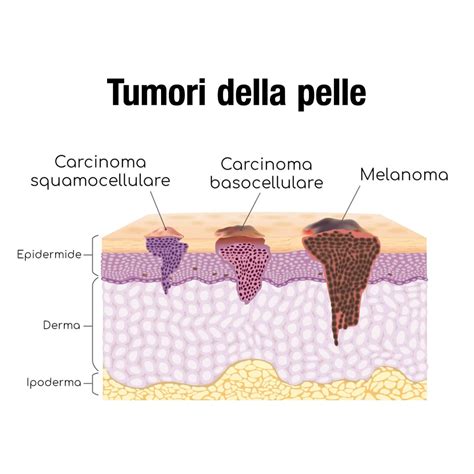Diverse manifestazioni di tumori cutanei comuni