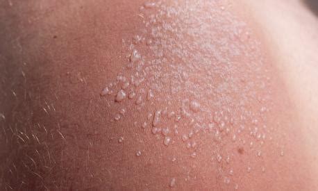 illustrazione dermatite polimorfa solare
