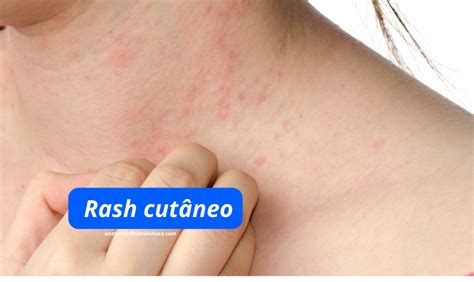 Rash cutaneo da dermatite solare