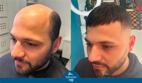 Patch cutanea come una toppa