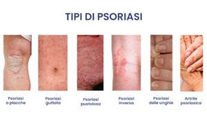 Paziente con placche psoriasiche sui gomiti
