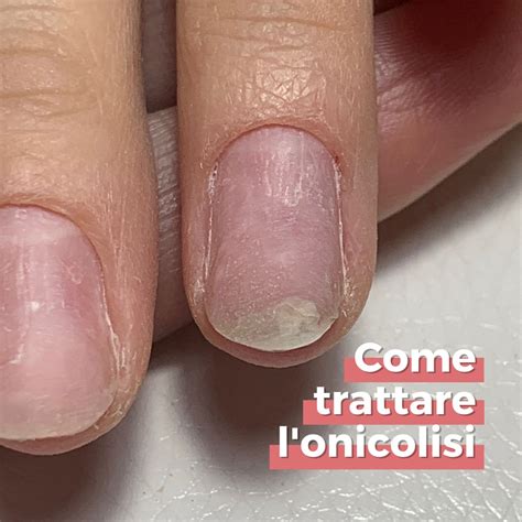 Unghia con punteggiatura psoriasica