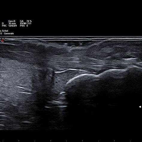 Ecografia articolare di un'articolazione infiammata