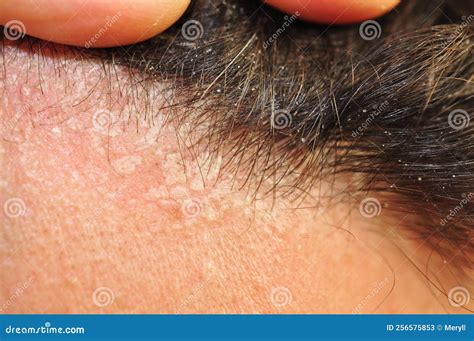 persona con scottatura solare sul cuoio capelluto