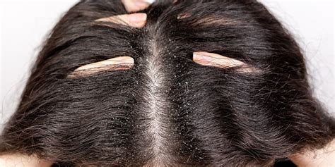 Schema che illustra le zone di applicazione delle fiale sul cuoio capelluto