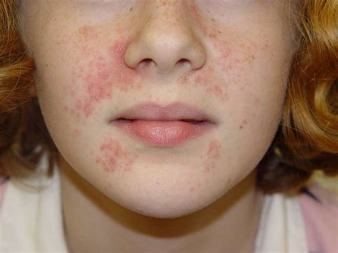 Bambino con dermatite atopica sul viso