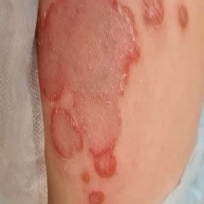 Pemfigo volgare con bolle e erosioni sulle mucose orali