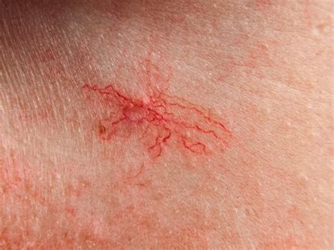 schema anatomico del viso con evidenziazione dei capillari superficiali