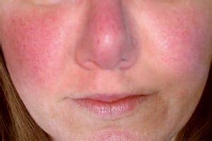 viso con arrossamento e gonfiore
