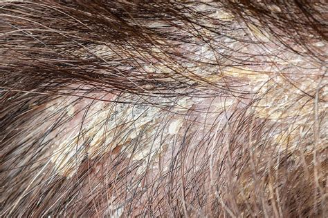 cuoio capelluto irritato dopo tintura